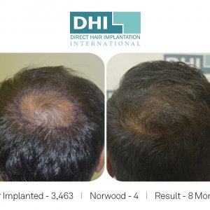 DHI - Hair Transplant Success Story