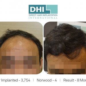 DHI - Hair Transplant Success Story 1