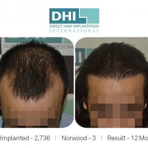 DHI - Hair Transplant Success Story 2