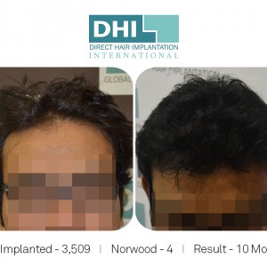DHI - Hair Transplant Success Story 3
