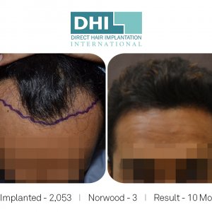 DHI - Hair Transplant Success Story 4