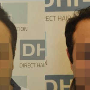 DHI - Hair Transplant Success Story 6