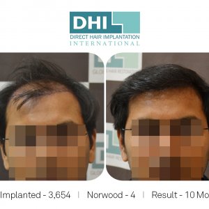 DHI - Hair Transplant Success Story 7