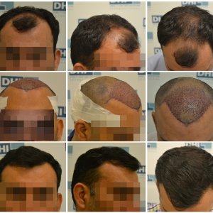 Hair Transplant Amazing Results