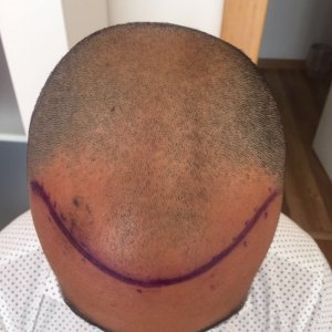 FUE 3250 GREFT BY DR. BİCER