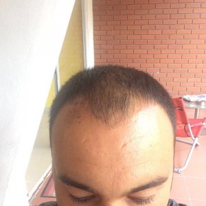 FUE 3250 GREFT BY DR. BİCER