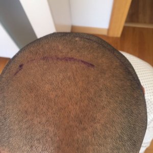 FUE 3250 GREFT BY DR. BİCER