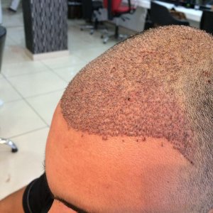 FUE 3250 GREFT BY DR. BİCER