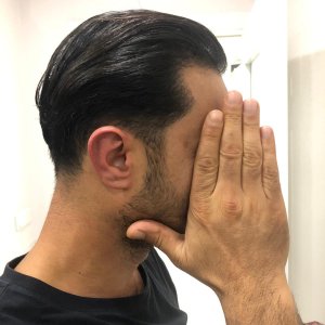 FUE 3250 GREFT BY DR. BİCER