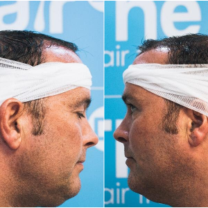 6. before-placement-sides-ben-thornley.png