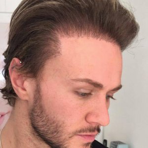 Kyle Christie bad hair transplant.jpg