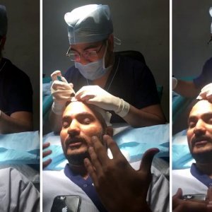 Patient Feedback- Patient Shares His Feedback Regarding Hair Transplant With DHI Technique