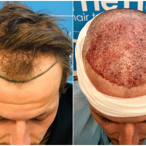 before-placement-dr-arshad-hair-dr-fue-hair-transplant-top.jpg
