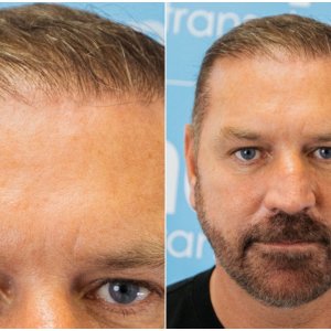after-hairline-dr-arshad-hair-dr.jpg