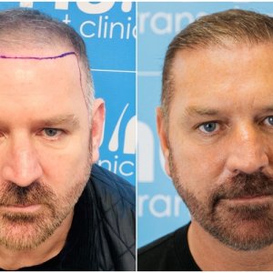 before-after-fue-dr-arshad-hair-dr-face.jpg