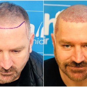 before-placement-dr-arshad-hair-dr.jpg