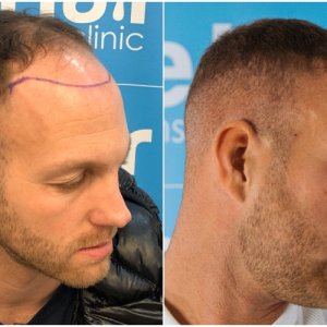 before-after-fue-hair-dr-dr-arshad-right.jpg