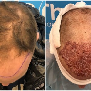 before-graft-placement-hairdr-dr-arshad.jpg