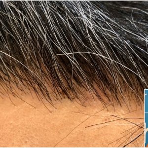 before-11-months-2148-fue-hair-dr-hailine.jpg