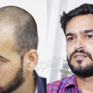 Best Hair Transplant Results - Medispa India