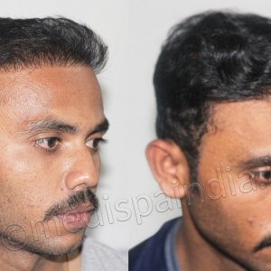 Bad Hair Transplant Repair at Medispa - Dr Suneet Soni