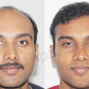 Hair transplant before and after results - Medispa India