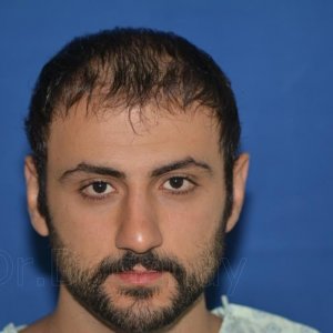 Identical twin hair transplant 1.jpg