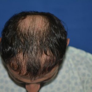 identical twin hair transplant 2.jpg
