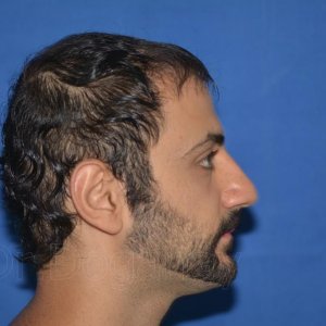 identical twin hair transplant 3.jpg