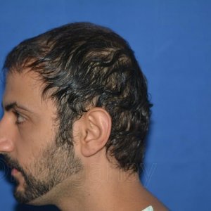 identical twin hair transplant 4.jpg