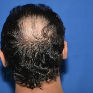 identical twin hair transplant 5.jpg