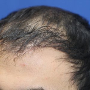 Identical twin hair transplant 8.jpg