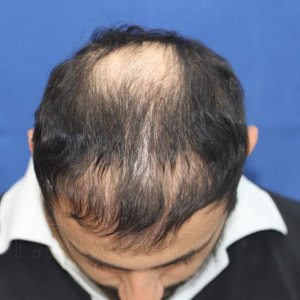 Identical twin hair transplant 9.jpg