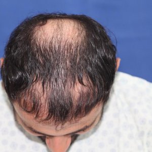 Identical twin hair transplant 10.jpg