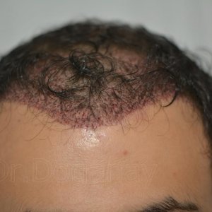 Identical twin hair transplant 11.jpg