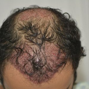 Identical twin hair transplant 12.jpg