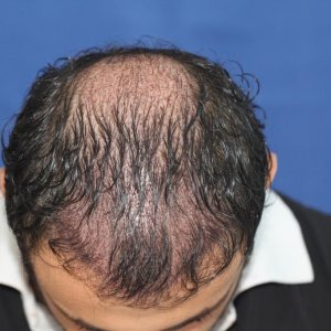 Identical twin hair transplant 13.jpg
