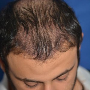 Identical twin hair transplant 14.jpg
