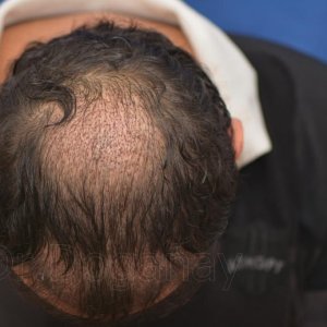 Identical twin hair transplant 15.jpg