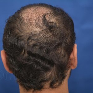 Identical twin hair transplant 16.jpg