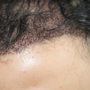 Identical twin hair transplant 17.jpg