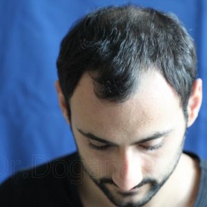Identical twin hair transplant 18.jpg