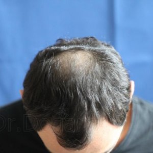 Identical twin hair transplant 19.jpg