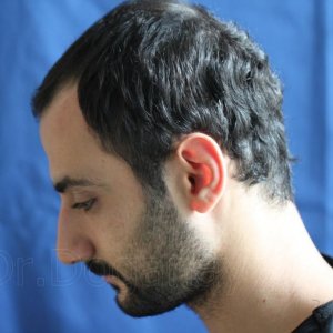 Identical twin hair transplant 20.jpg