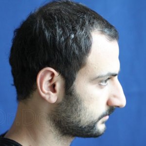 Identical twin hair transplant 21.jpg