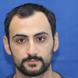 Identical twin hair transplant 22.jpg