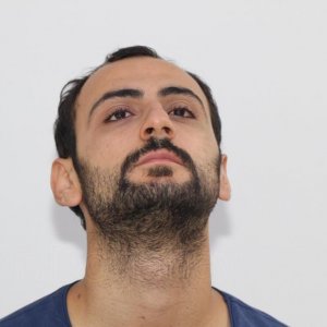 Identical twin hair transplant 24.jpg