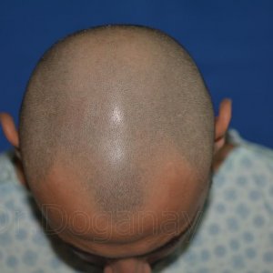 Identical twin hair transplant 25.jpg