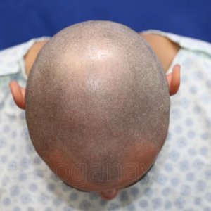 Identical twin hair transplant 26.jpg