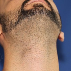Identical twin hair transplant 27.jpg